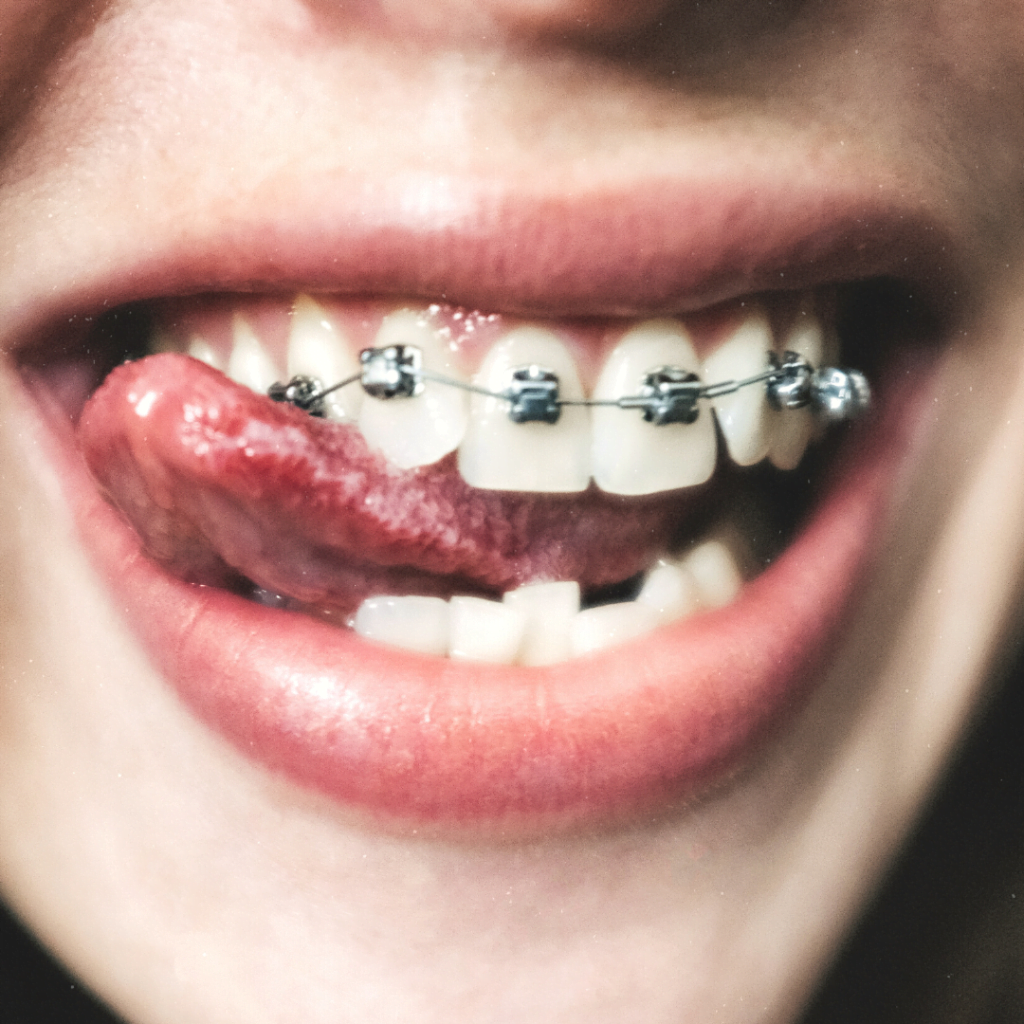 best dental clinic for advanced braces in hyderabad
