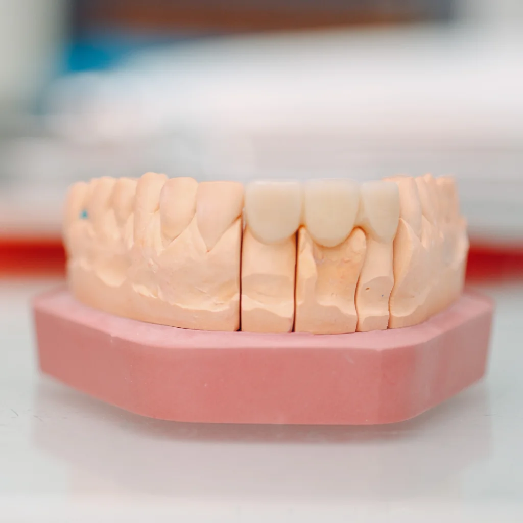 Best Zirconia Crowns and Bridges Hyderabad 1 best dental clinic for crowns and bridges in hyderabad