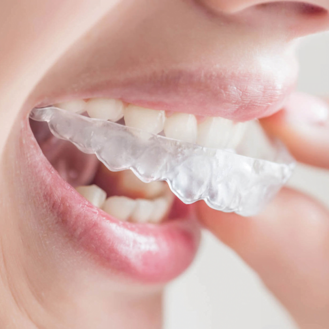 #1 Best Invisible Braces or Aligners in Hyderabad - Dr. Swetha Platina ...